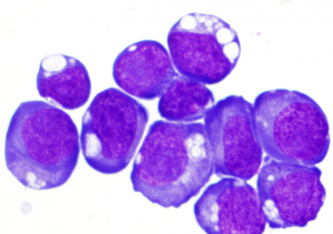 Multiple Myeloma Cells