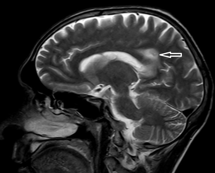 Fingolimod (Gilenya): Warning about rare cases of progressive multifocal leukoencephalopathy (PML)