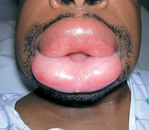Patient of African American descent suffering from angioedema