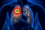 Remarkable: Pembrolizumab (Keytruda) now also for advanced non-small cell lung cancer (NSCLC)