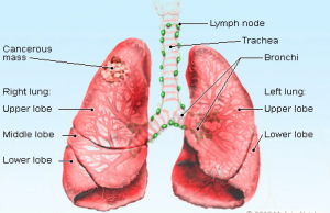 Lung Cancer I