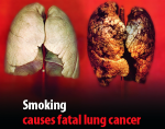 Lung Cancer II