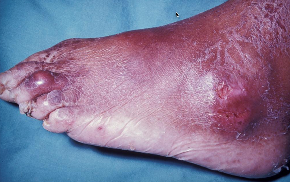 Is there help for patients suffering from gout? Lesinurad  (Zurampic) approved for the treatment of high blood uric acid levels