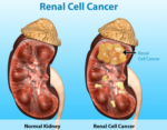 Renal Cell Cancer II