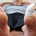 Risk of leg and foot amputations under Canagliflozin (Invokana, Invokamet)