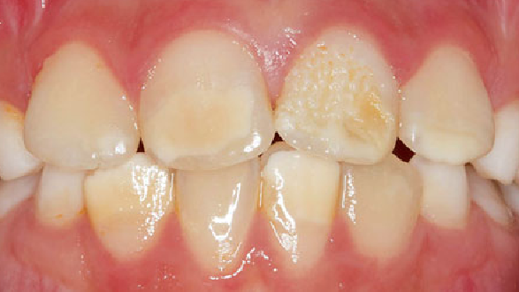 Calcium deficiency in cells due to ORAI1 gene mutation leads to damaged tooth enamel
