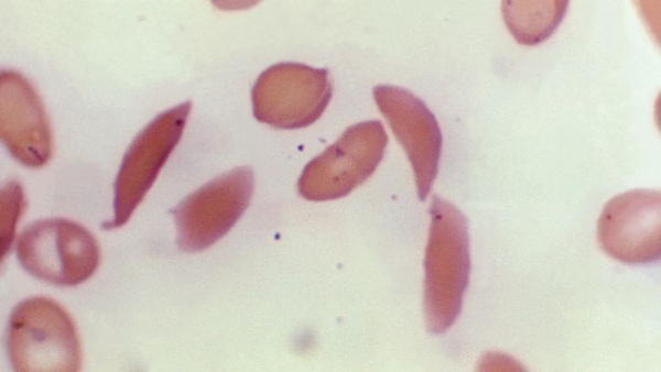 Anemia falciforme: fármaco de tijeras genéticas aprobado por primera vez