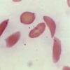 Anemia falciforme: medicamento de tesoura genética aprovado pela primeira vez